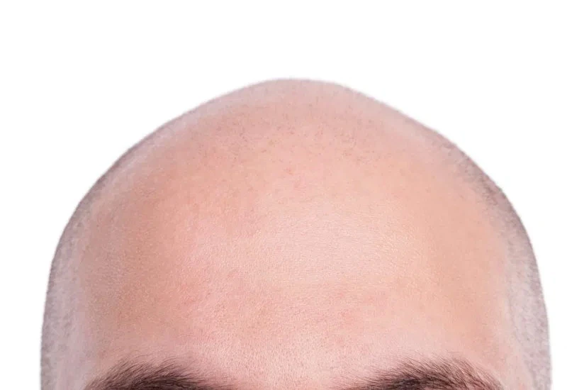 Koji muškarci brže ćelave?