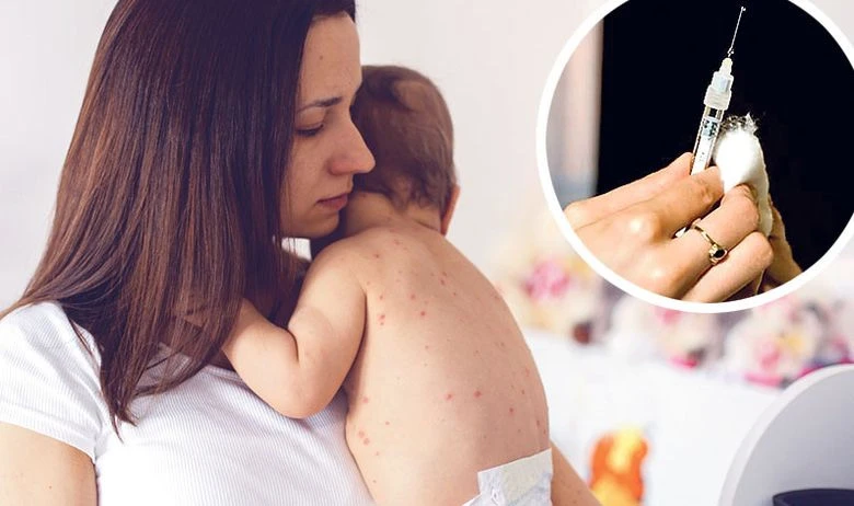 Raste broj oboljelih od ospica: Njemačka uvodi nove mjere