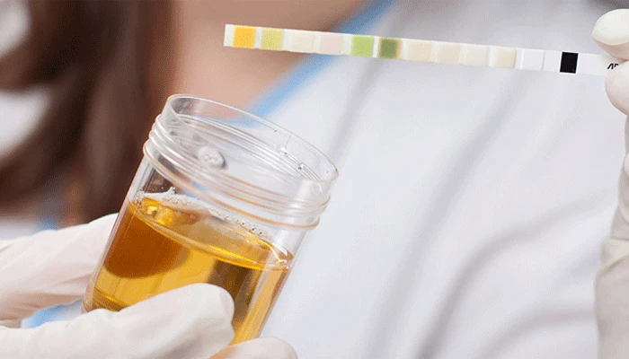 Najnoviji testovi urina mogli bi pomoći u tretiranju raka prostate
