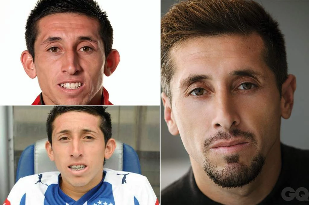 Išao pod nož: Hector "Dumbo" Herrera ima novo lice!