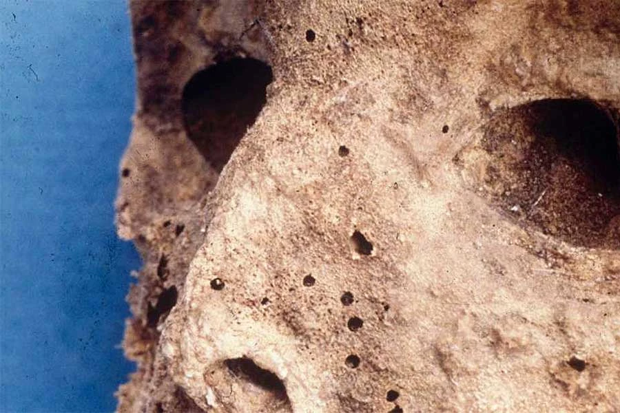 Virus hepatitisa B kružio je još u kameno doba