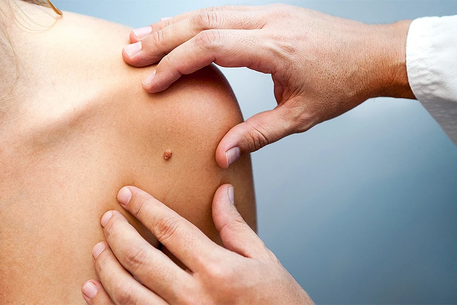 Što se tiče Federacije, oboljeli od melanoma mogu umrijeti