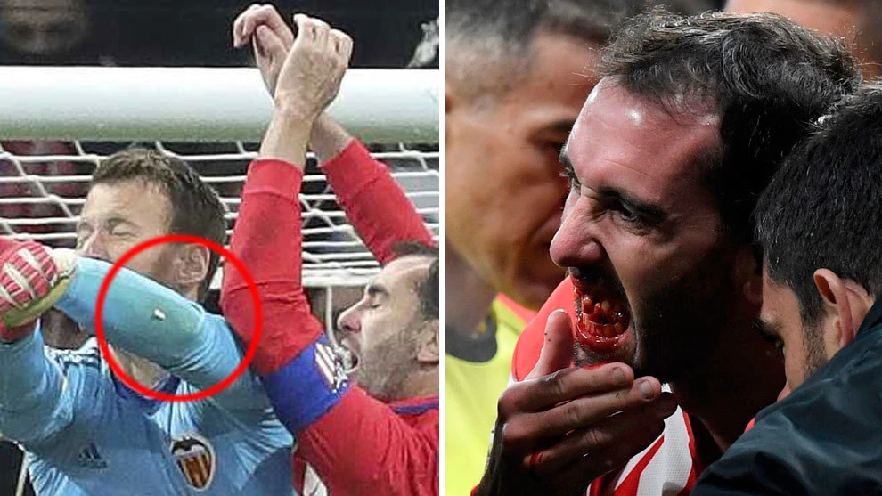 Diego Godín ostao bez nekoliko zuba na utakmici protiv Valencije