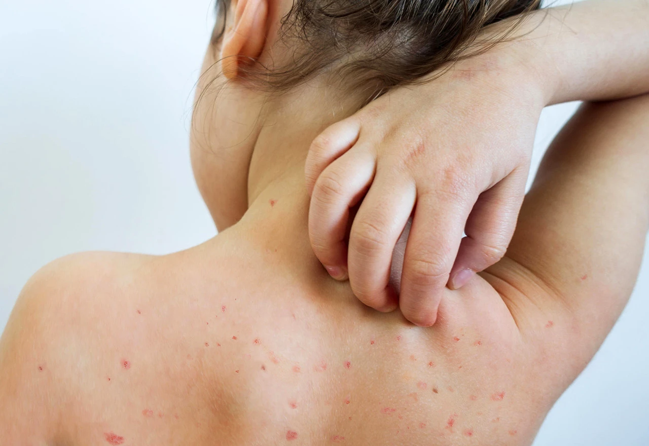 Epidemija morbila u BiH se ubrzano širi
