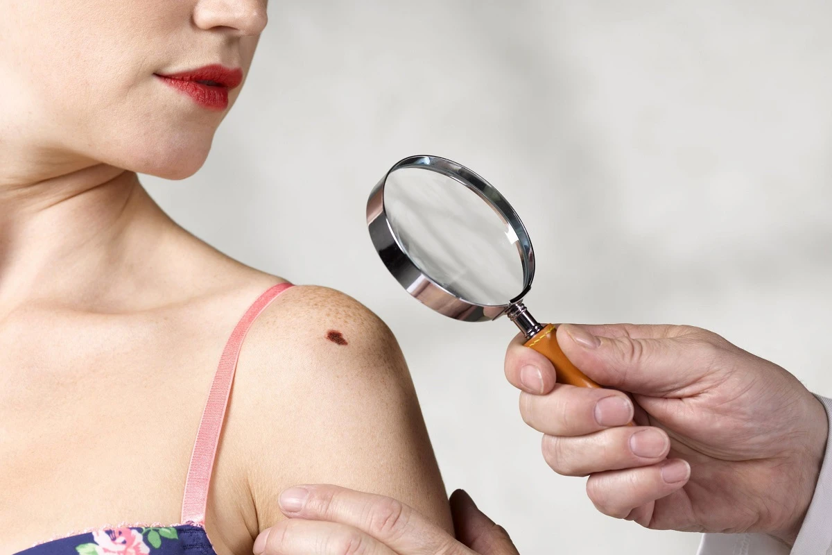 Cjepivo - Veliki napredak u liječenju melanoma