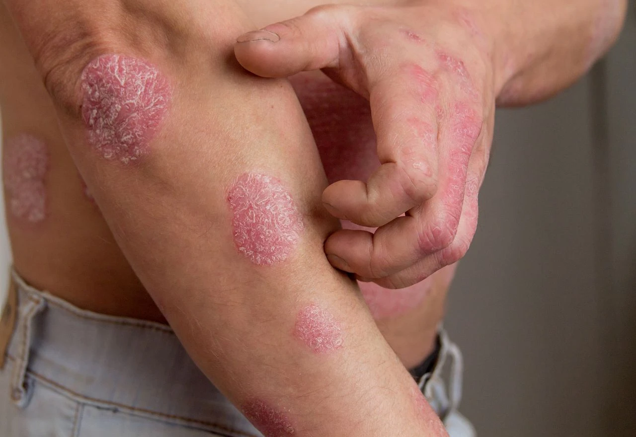 6 sezonskih okidača psorijaze koje treba izbjegavati