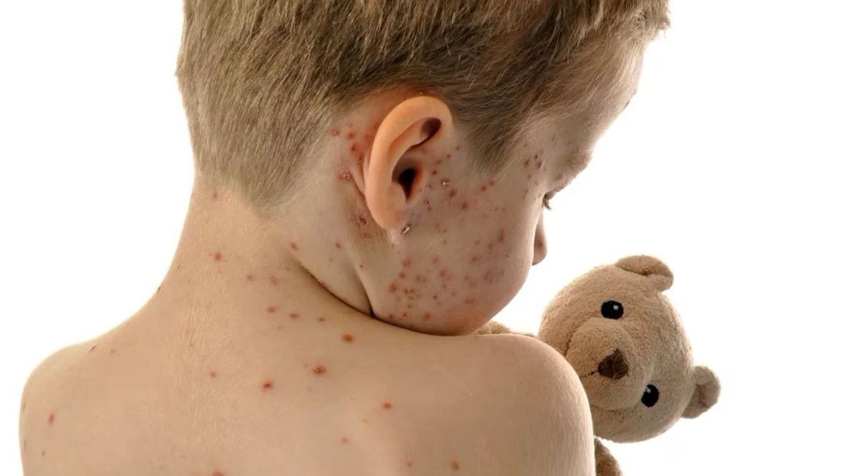Morbili i veliki kašlj predstavljaju za našu zdravstvenu službu veliki problem