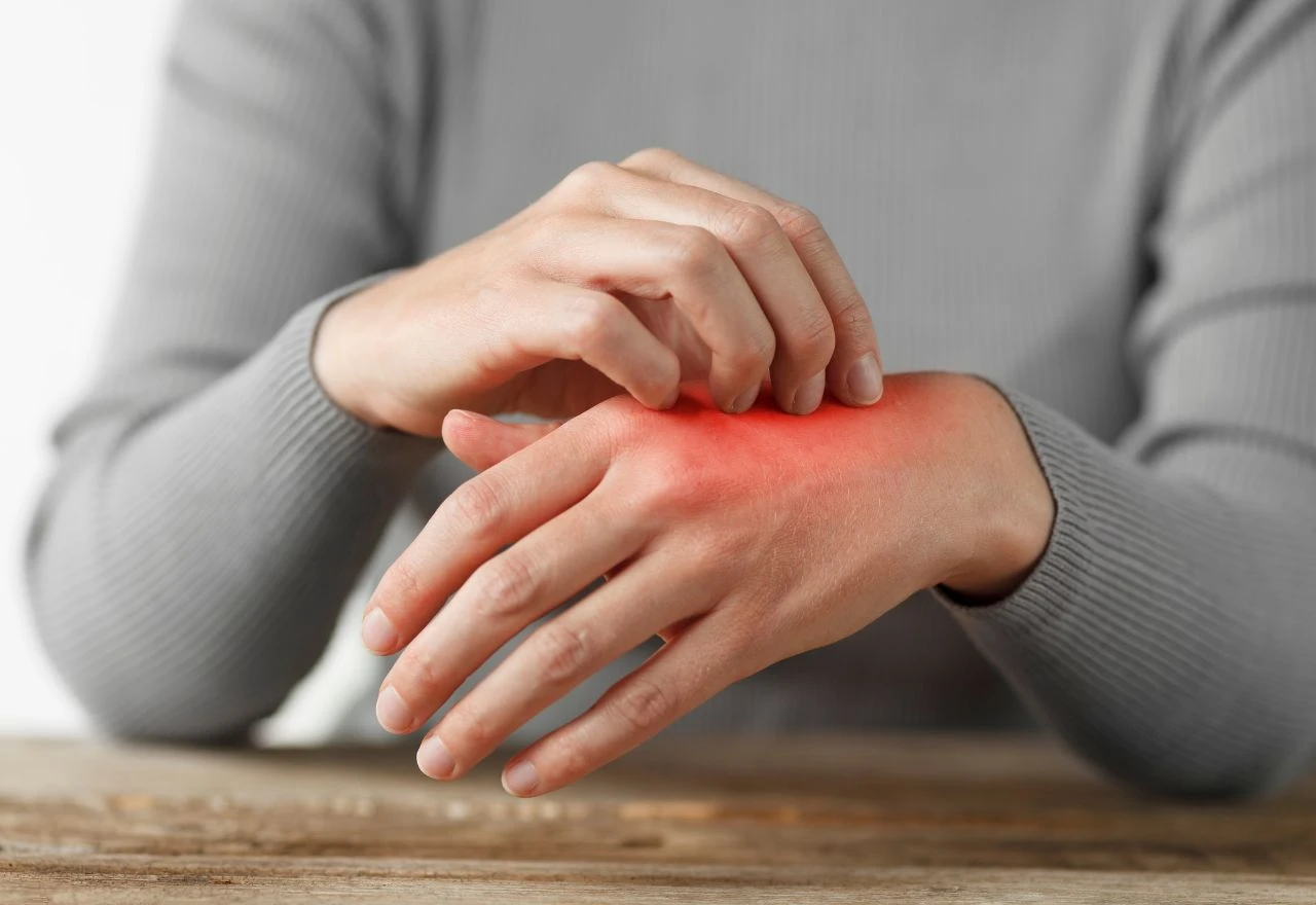 Ovo su prirodna rješenja za psorijazu	