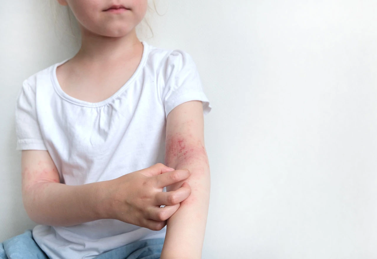Znanstvenici otkrili funkcionalnu metodu u terapiji neurodermatitisa