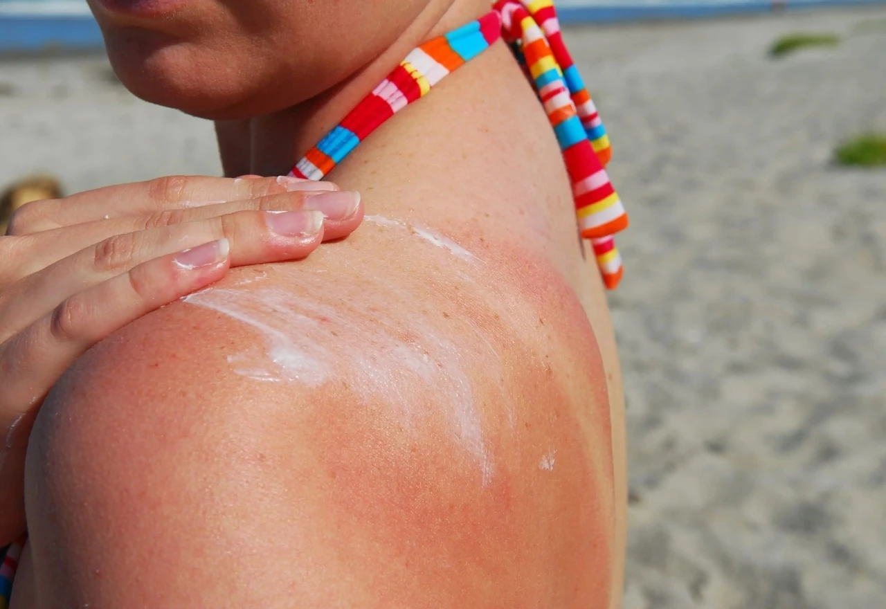 Upozorenje građanima: Melanom pogađa osobe bilo koje dobi!