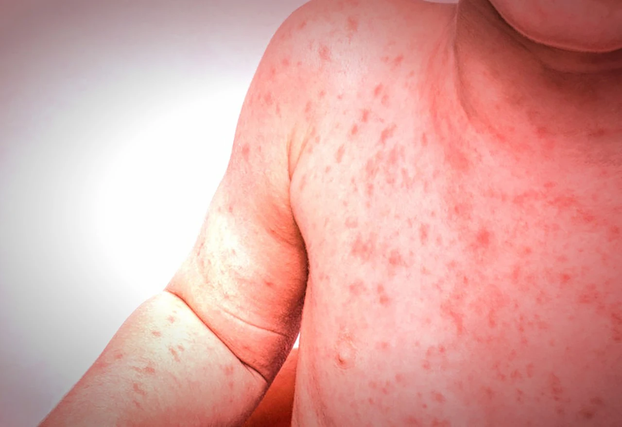Stručnjaci strahuju od izbijanja epidemije ospica na Balkanu