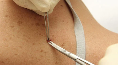 Završna konferencija projekta o ranom otkrivanju melanoma kože, sluznica i oka