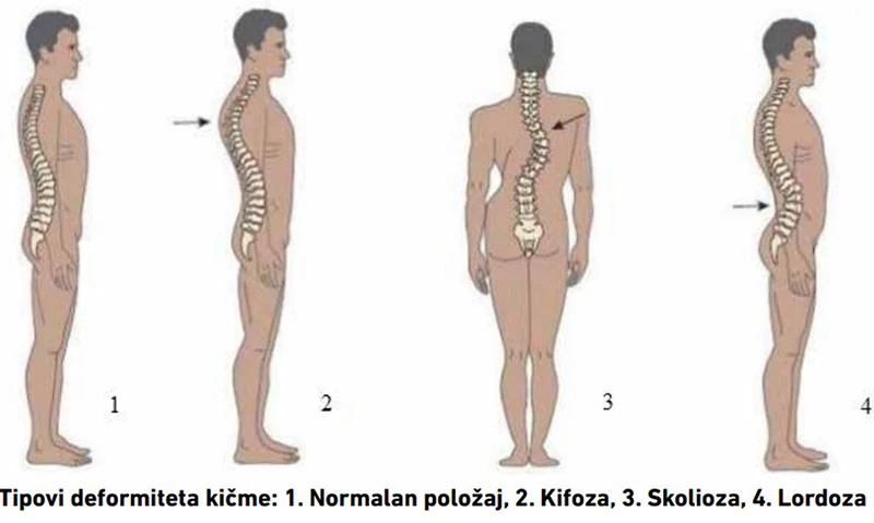 Sve više učenika ima problem s lokomotornim sistemom