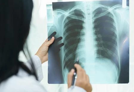 Studija pokazala koliko ozbiljno koronavirus uništi pluća