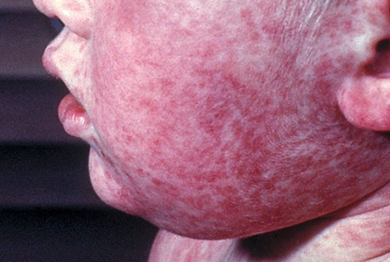 Izvanredno stanje zbog epidemije ospica