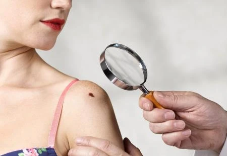 Pojava melanoma u BiH u porastu