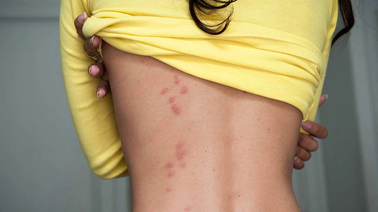 Sve više ljudi traži liječničku pomoć zbog insekata 