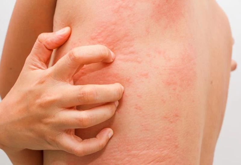 U Federaciji BiH nema epidemije šuge