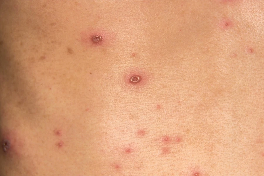 Epidemija morbila u Istočnom Sarajevu