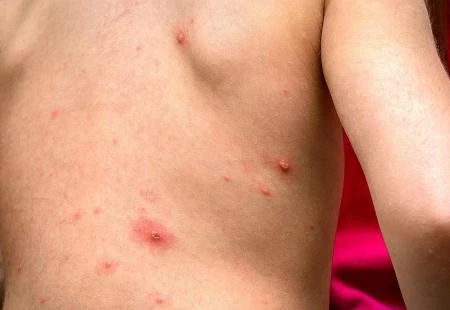 Registriran 41 slučaj ospica:  Čak 93 posto oboljelih nisu bili cijepljeni ili su nepotpuno cijepljeni