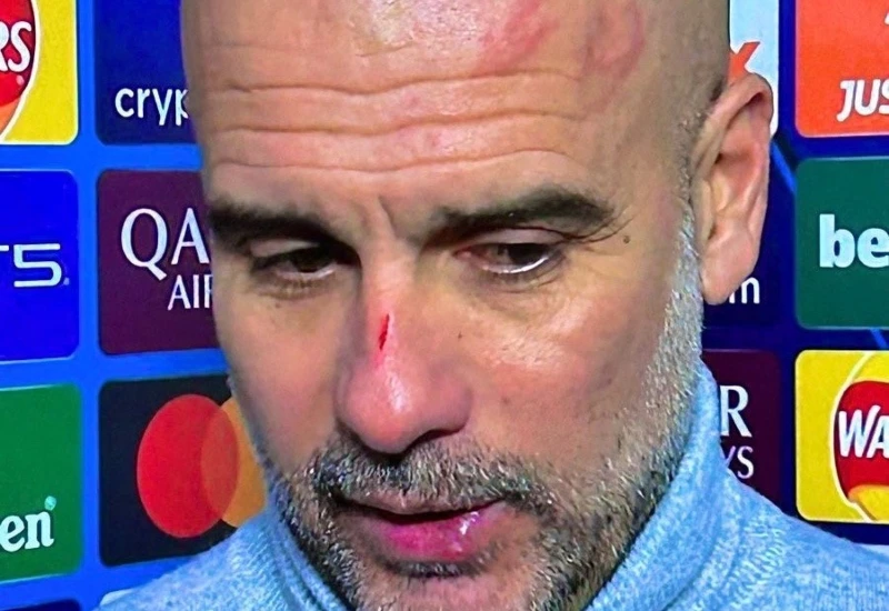 Guardiola o krvavom nosu i modricama: "Želim se ozlijediti"