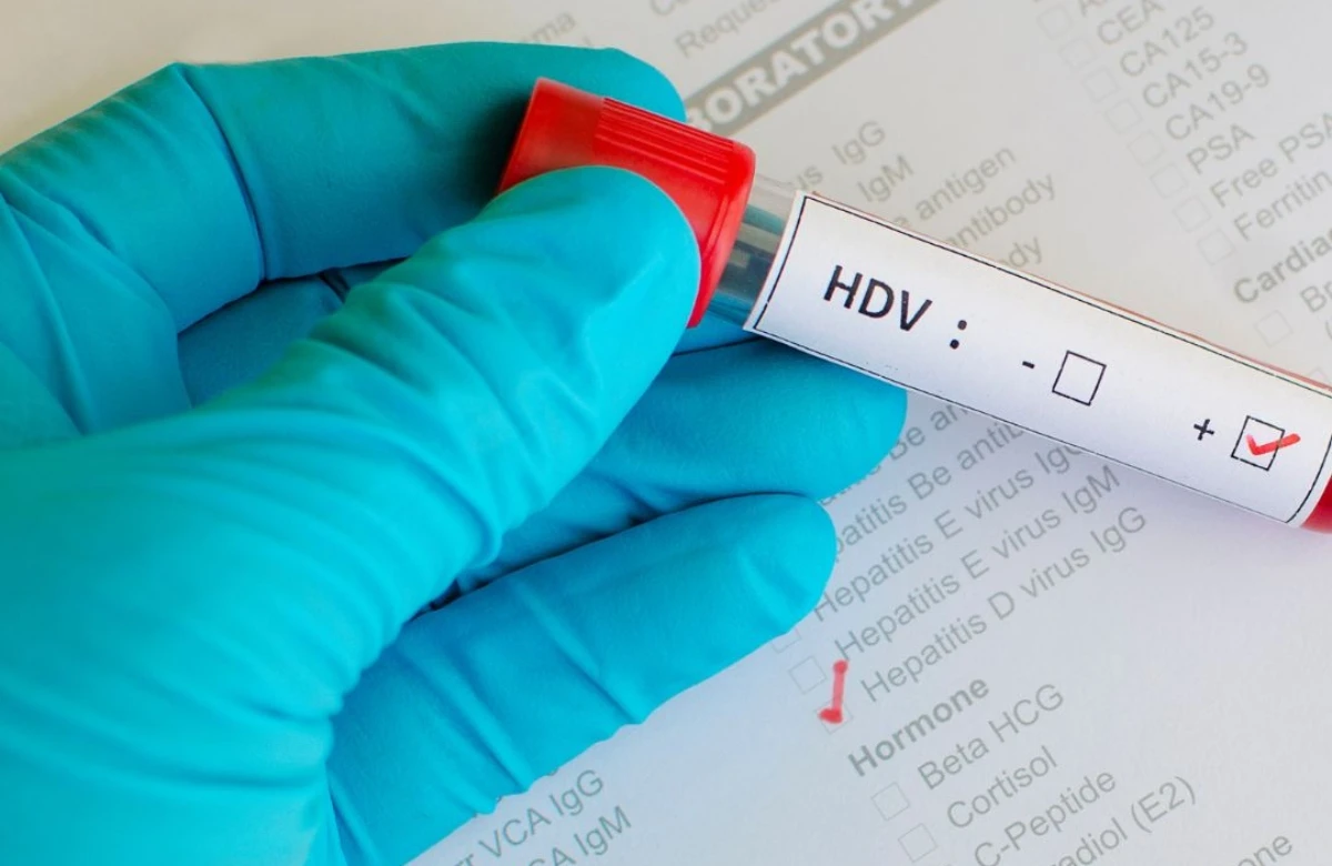 Hepatitis D često ostaje neotkriven, uprkos mogućnostima liječenja