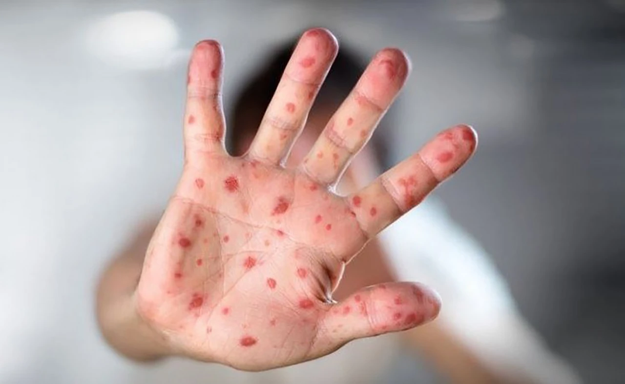 Zbog novca se ne želi proglasiti epidemija morbila u Federaciji?!
