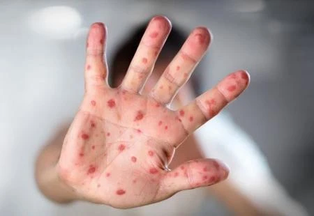 Epidemija morbila u Banja Luci