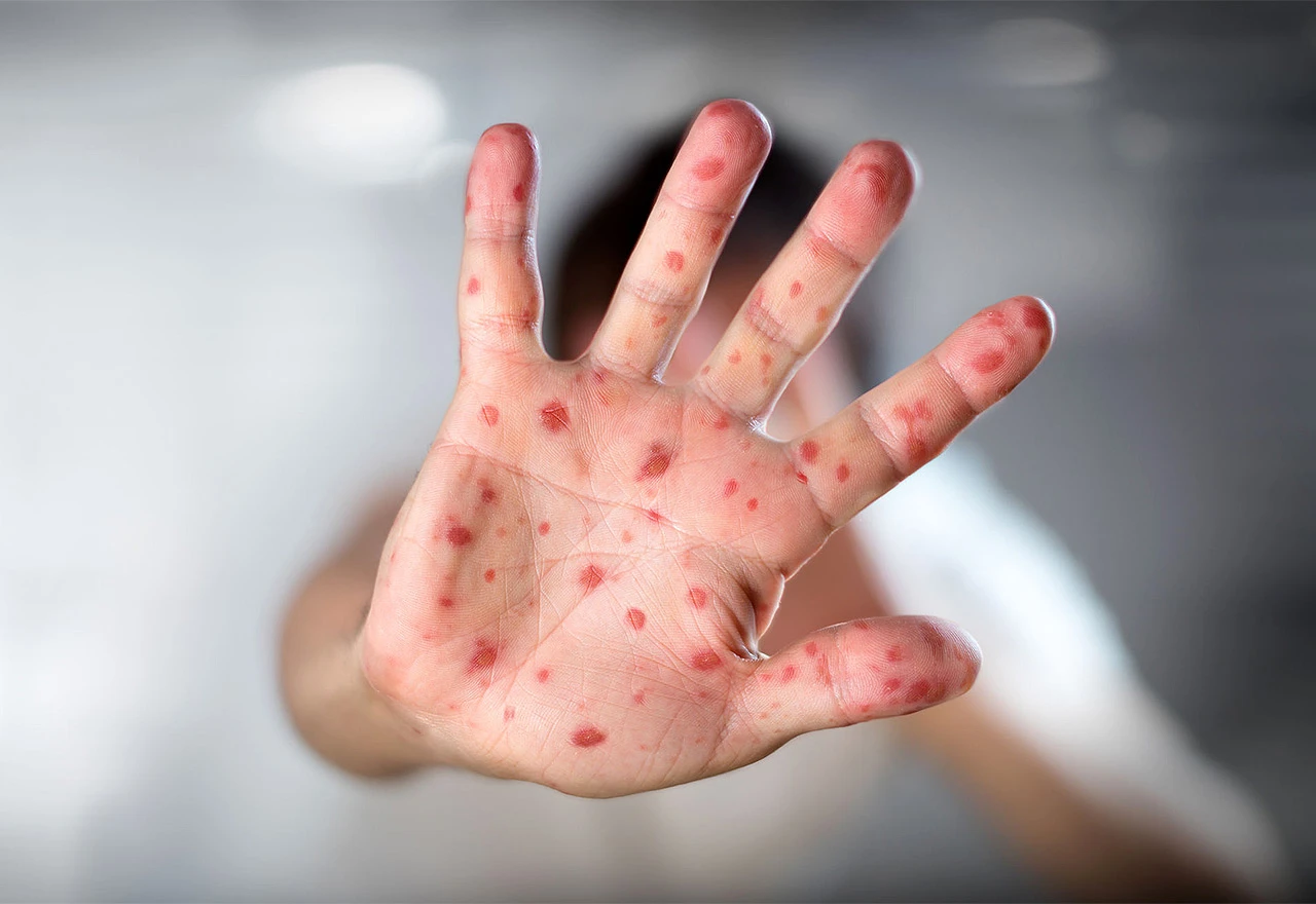 U Srbiji sedma žrtva ospica, preminula medicinska djelatnica