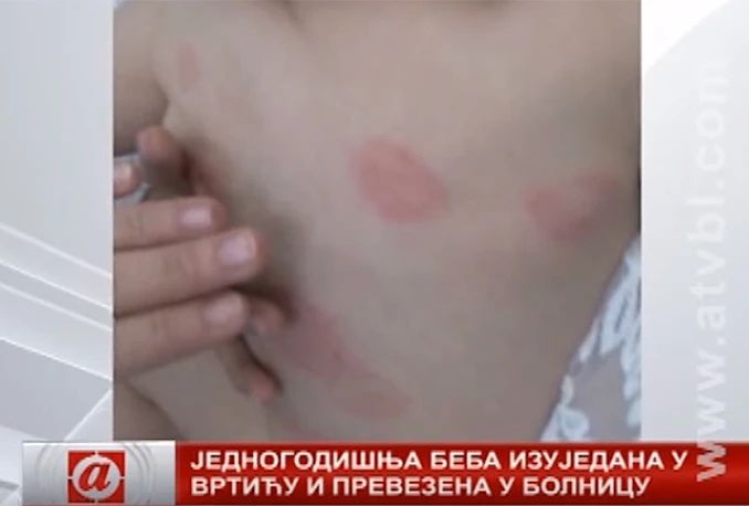 Više osoba ispitano zbog slučaja izujedane djevojčice
