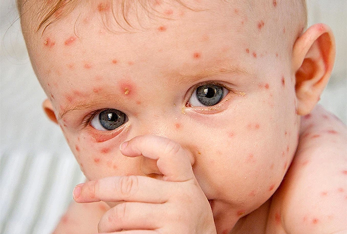 Zbog neodgovornosti roditelja, opet prijeti epidemija ospica u BiH
