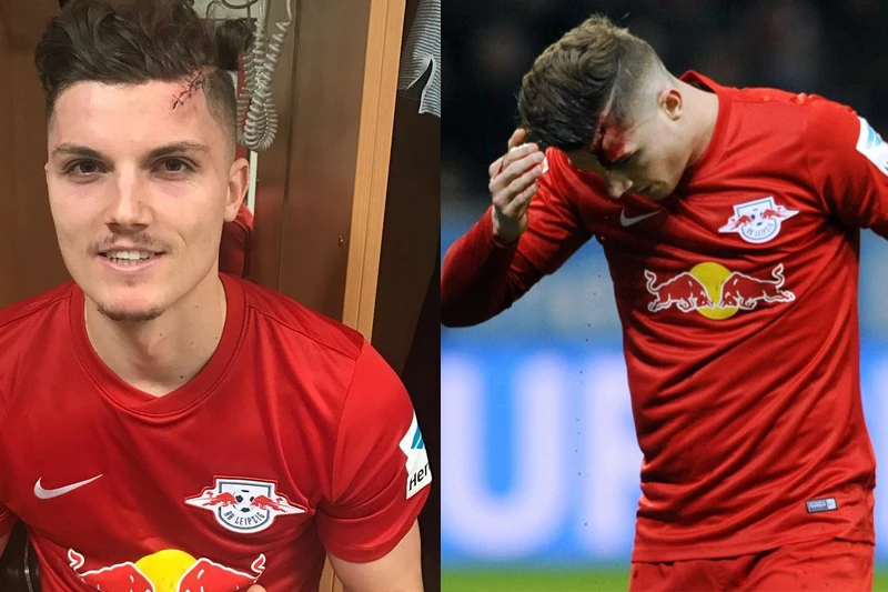 Kad si ispred slavnog Bayern pet šavova na glavi nije ništa!