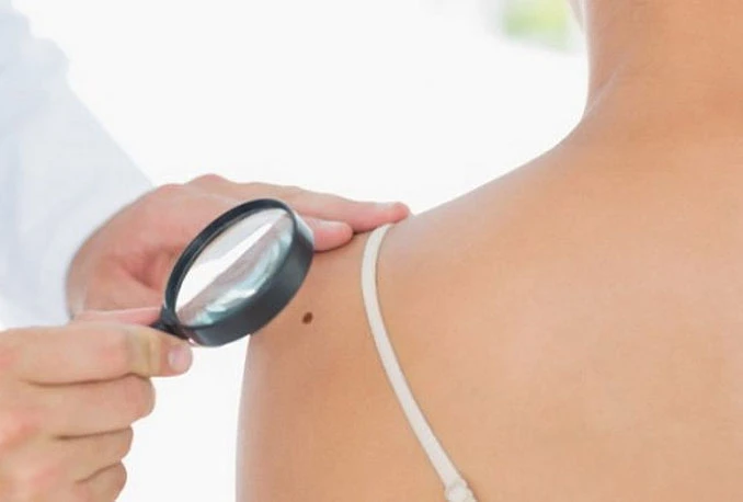 Više od 11 madeža na ruci pokazatelj rizika za pojavu melanoma