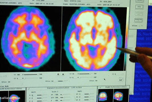 Znanstvenici kompanije Nestlé pomažu uspostaviti centar za istraživanje Alzheimerove bolesti