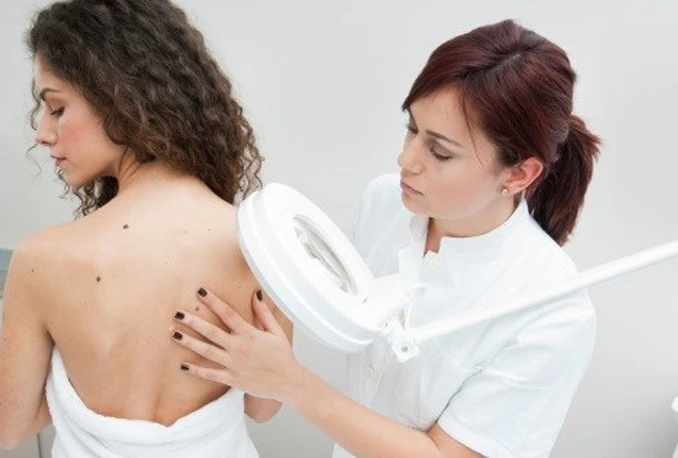 Broj oboljelih od melanoma svakodnevno raste