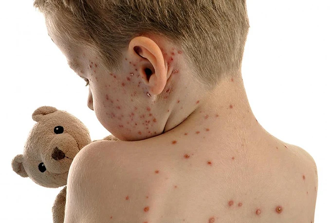 Epidemija morbila posljedica lošeg cijepljenja