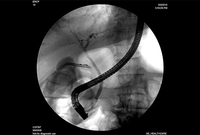Prvi put izveden ERCP zahvat