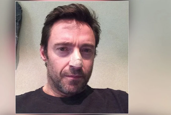 Slavni Glumac Hugh Jackman putem Instagrama otkrio da boluje od raka kože