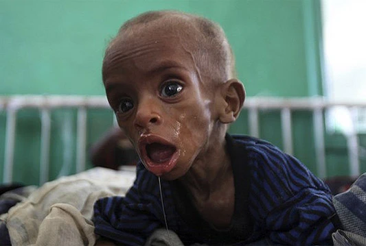 Jedna od najvećih epidemija kolere ikada zabilježenih u zapadnoj Africi