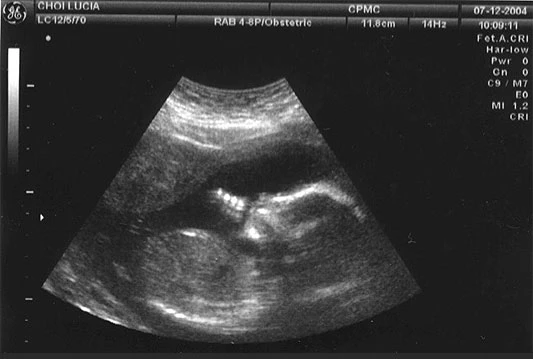 Velika Britanija: Skandal u vezi sa spolno selektiranim abortusima
