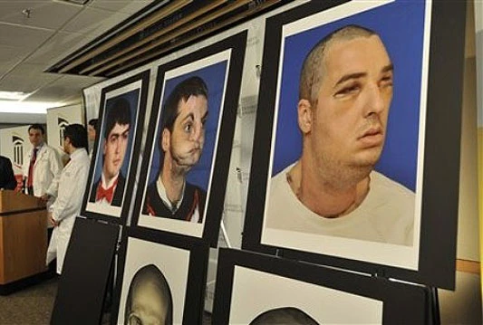 Liječnici u SAD-u izveli potpunu transplantaciju lica
