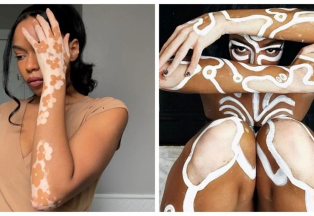 VIDEO | Vitiligo kao umjetnost: Ovo je priča o Amari i njezinom samoprihvaćanju