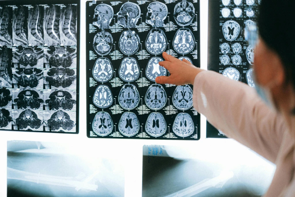 Novi lijek za dječje tumore mozga pokazao izniman uspjeh