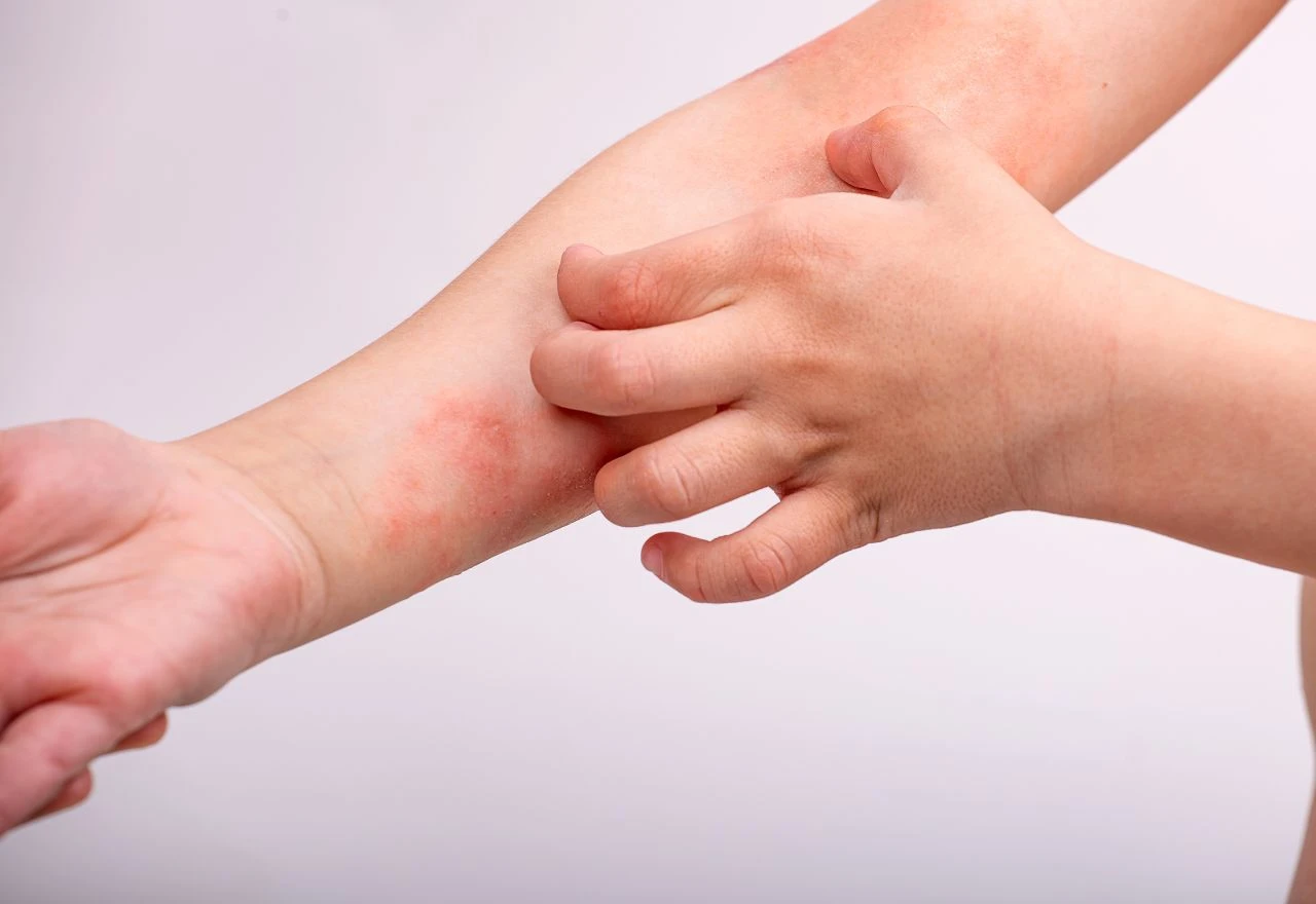 Imate li ove simptome na koži? Možda je riječ o ekcemu (evo kako ga smiriti)