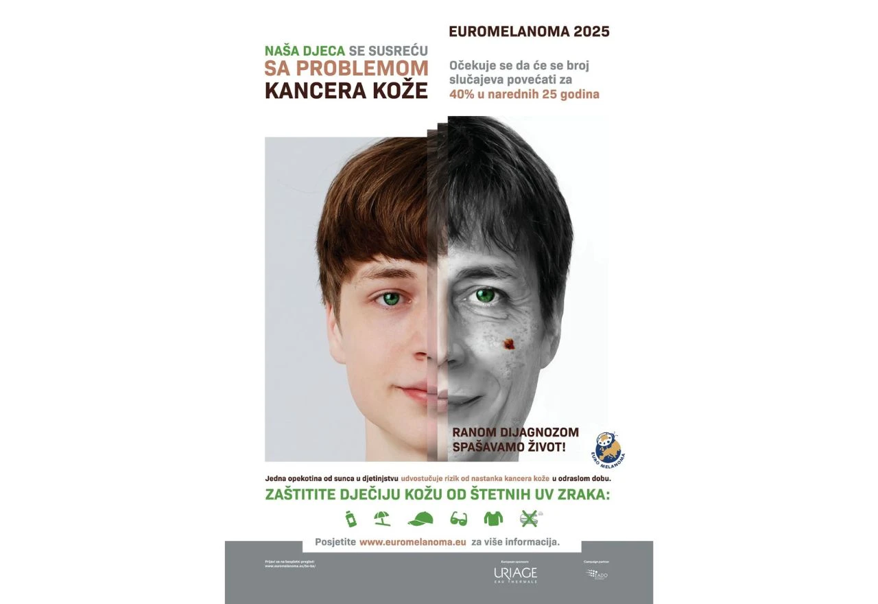 Mostar: Besplatni dermatološki pregledi povodom Europskog dana borbe protiv melanoma