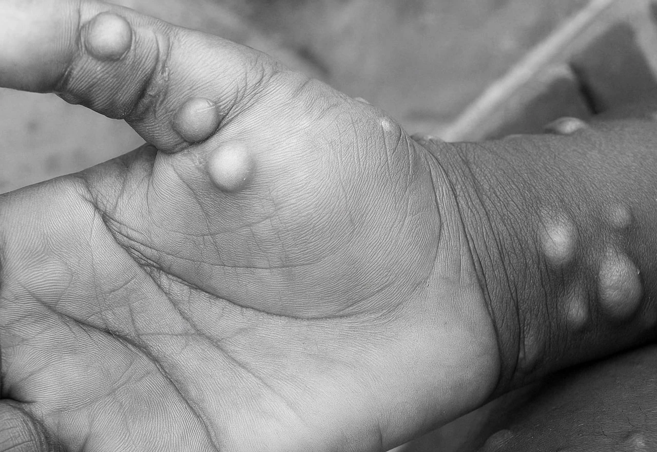 Prvi slučajevi majmunskih boginja potvrđeni u Sjevernoj Makedoniji