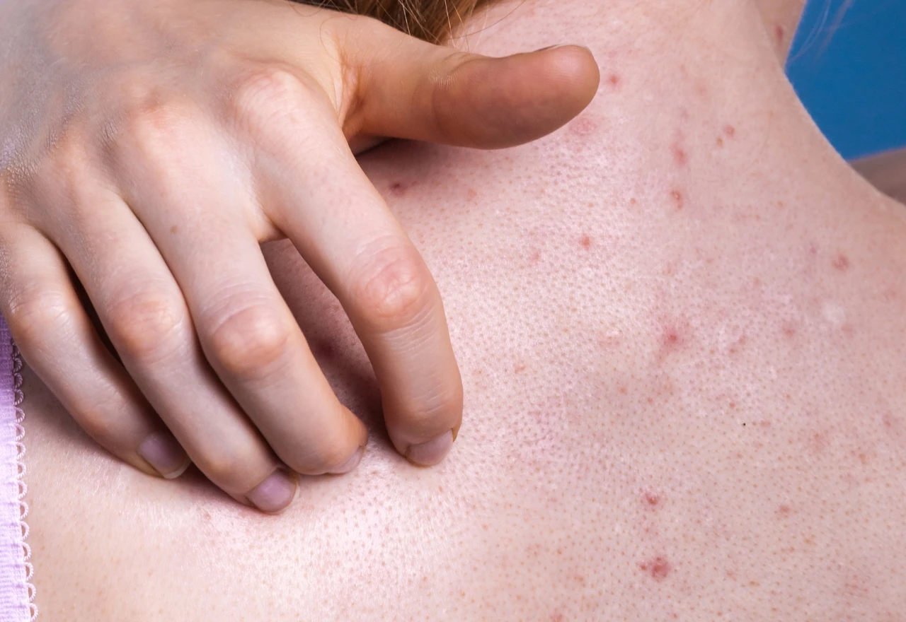 Akne na leđima: Dermatolozi otkrivaju 7 učinkovitih rješenja