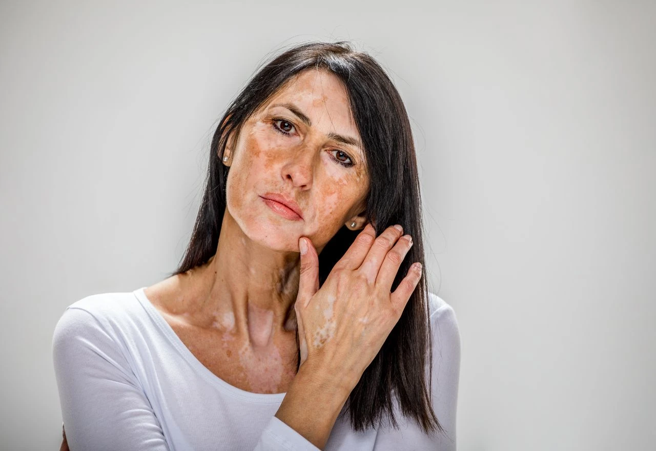 Vitiligo na koži – zašto nastaje i može li se izliječiti?