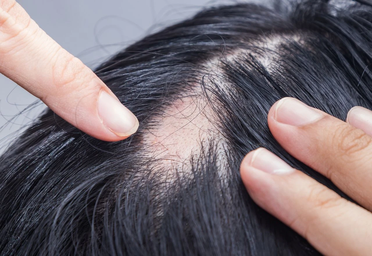 Može li kosa ponovo rasti nakon alopecije? Evo što kažu dermatolozi