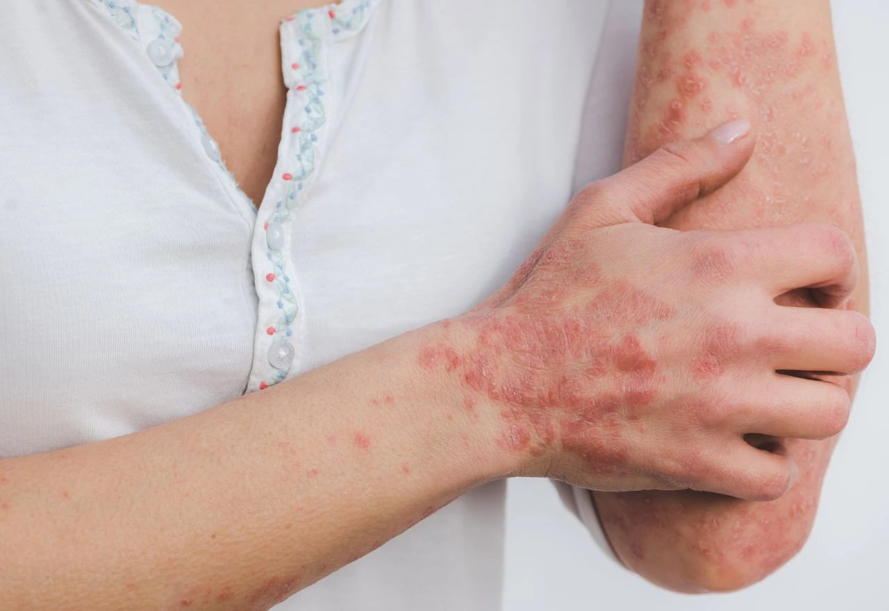 Zašto je psorijaza kod žena često teža i kako si možete pomoći?